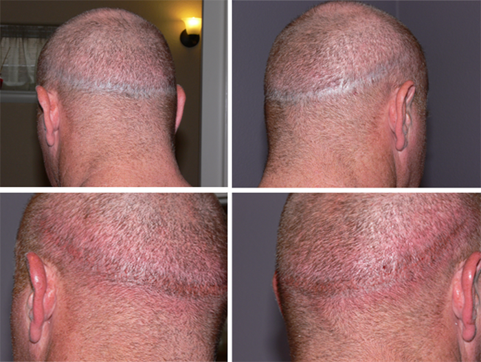 Scalp Before And Immediately After 