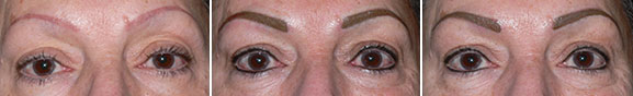 Before Brow Correction and Eyeliner, Immediately After, and Immediately After 2nd Touchup